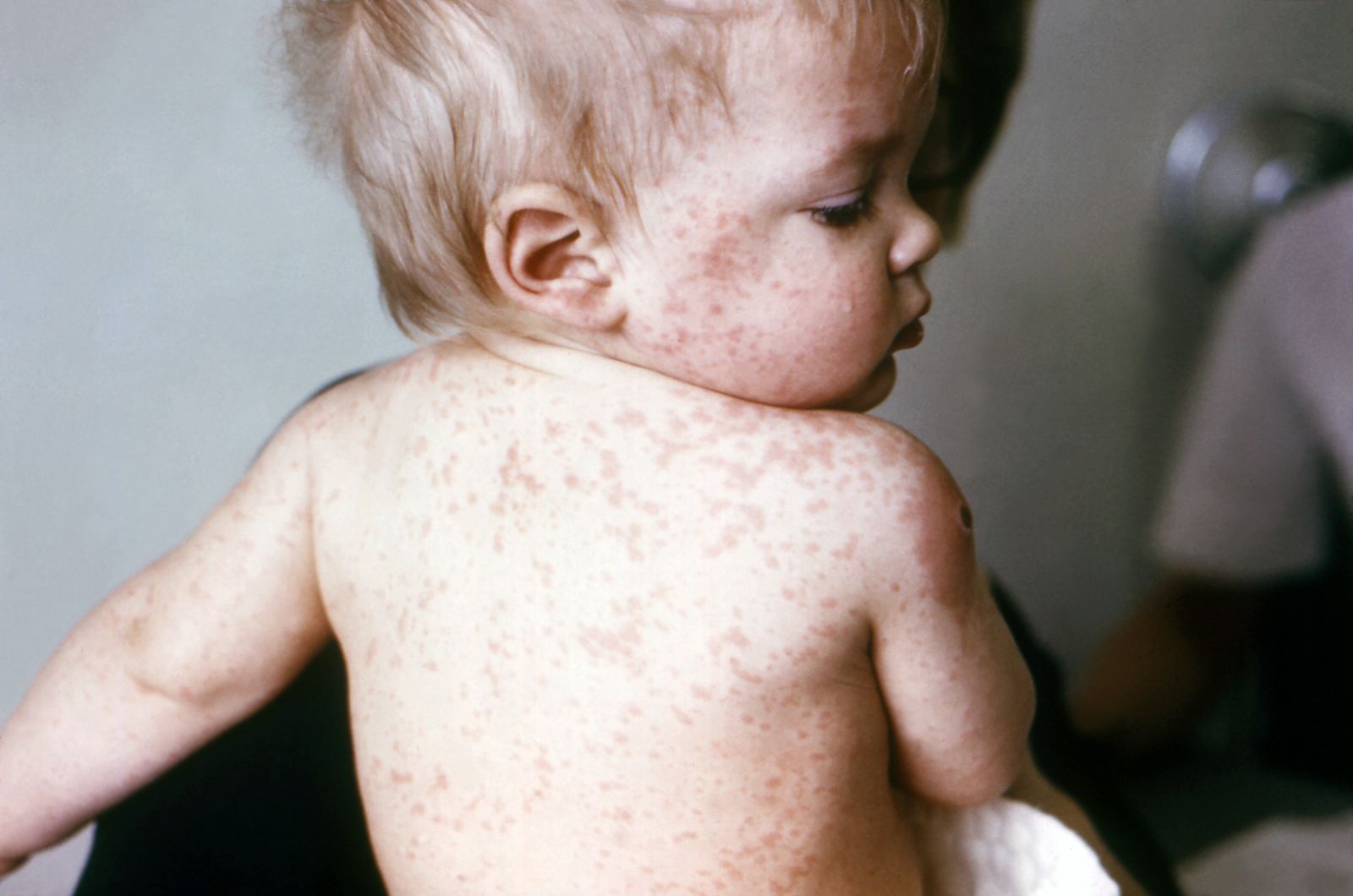 Bệnh sởi measles ở trẻ em1
