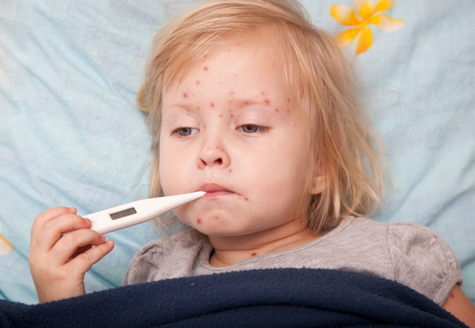 Bệnh sởi measles ở trẻ em 2