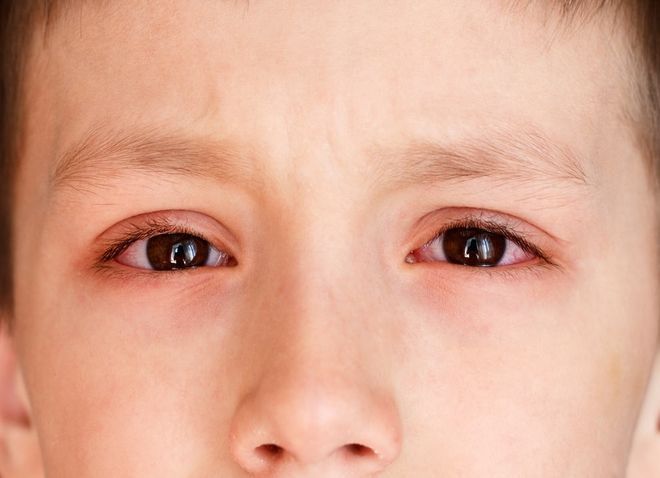 Bệnh đau mắt hột ở trẻ em và những điều phụ huynh cần chú ý 1