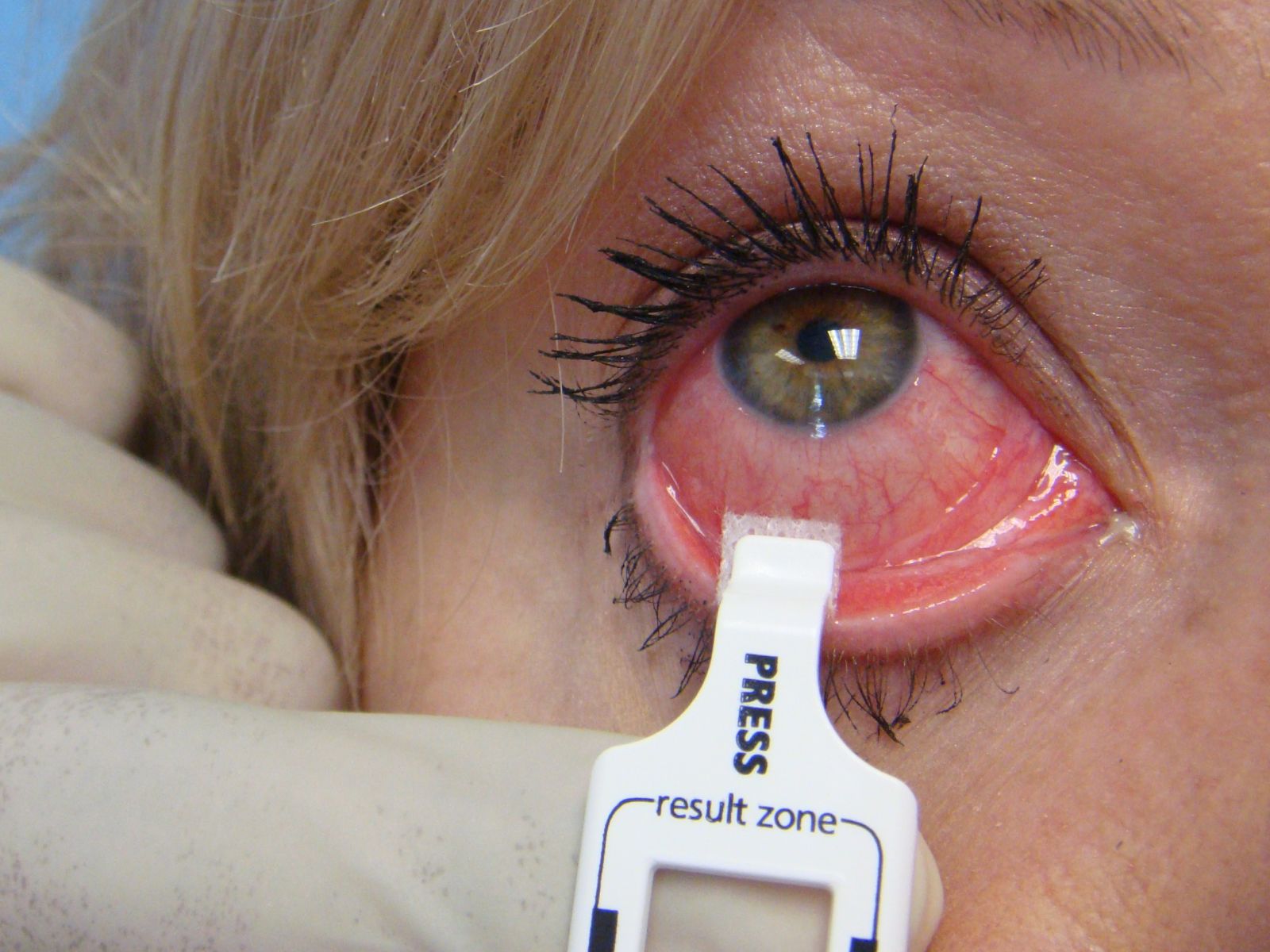 Cách chữa bệnh đau mắt đỏ ở trẻ em khỏi nhanh chóng