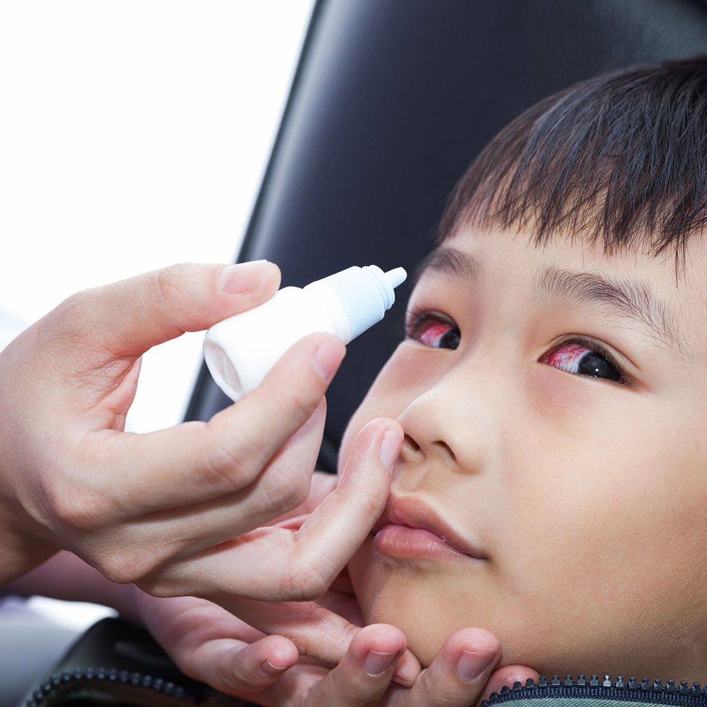 Cách chữa bệnh đau mắt đỏ ở trẻ em khỏi nhanh chóng 3