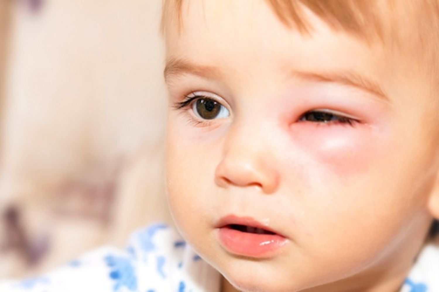 Nằm lòng hiện tượng đau mắt đỏ ở trẻ em 2