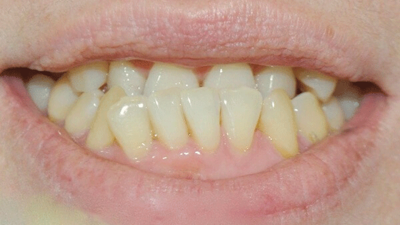 Thế nào là răng mọc quặp? Phương pháp chữa răng mọc quặp 1