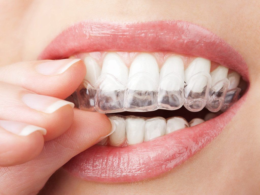 Thế nào là răng mọc quặp? Phương pháp chữa răng mọc quặp 3