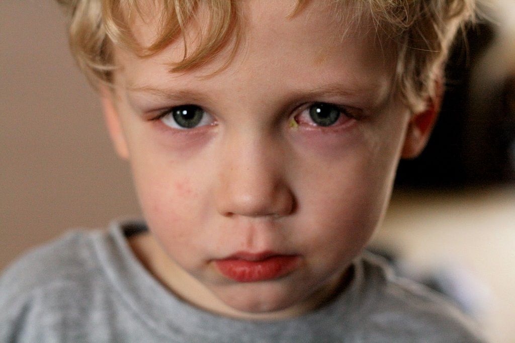 Trẻ bị đau mắt đỏ phải chăm sóc như thế nào 1