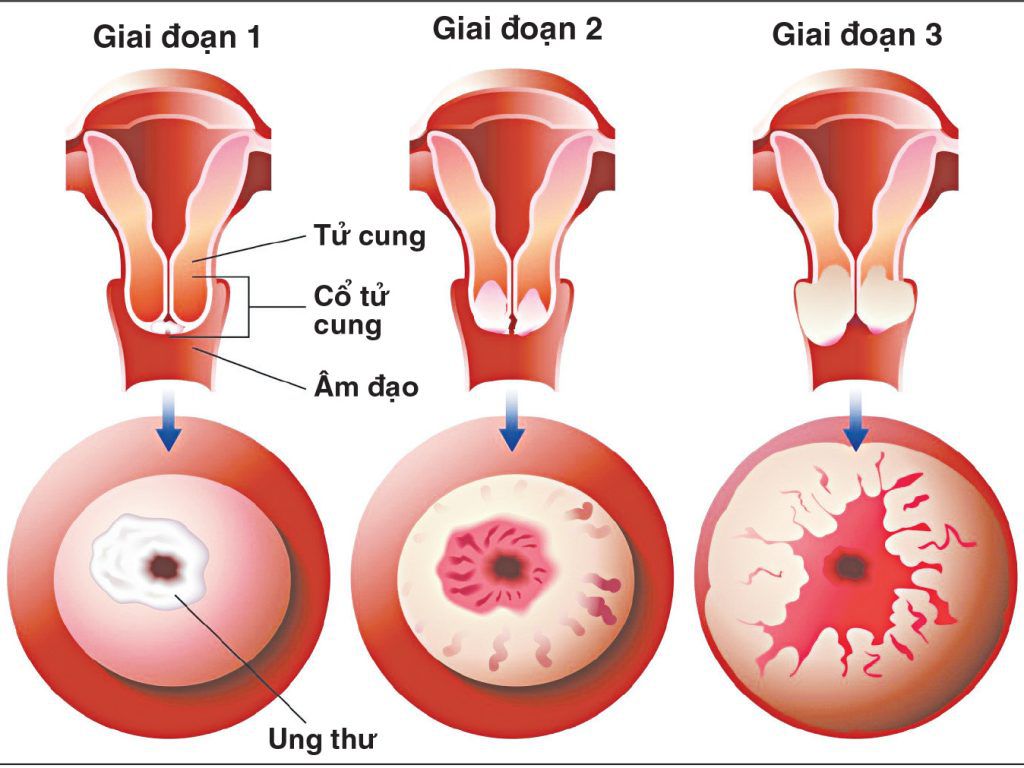 Ung thư cổ tử cung di căn hạch: Nguyên nhân và cách điều trị
