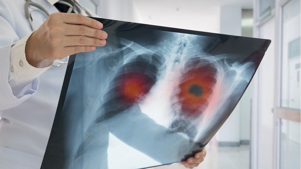Ung thư cổ tử cung di căn phổi gây ra những biến chứng gì? 1