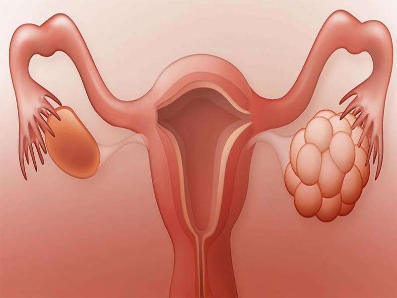 Ảnh hưởng của ung thư buồng trứng khi mang thai 1