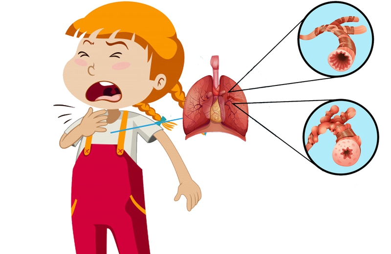 Những mẹo dân gian chữa viêm phổi cho trẻ có thể bạn chưa biết 3