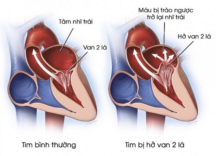 Những thông tin bạn cần biết về cách điều trị hở van tim 2 lá 1