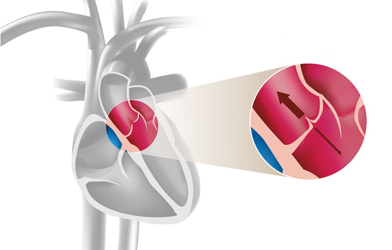 Tìm hiểu thông tin: Hở van tim sống được bao lâu?