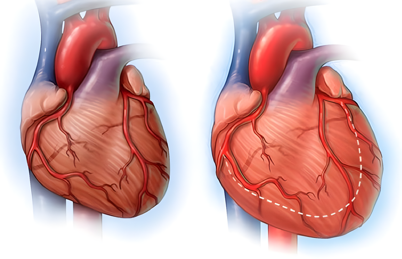 Giải đáp thông tin: Vì sao hẹp van 2 lá gây suy tim phải?