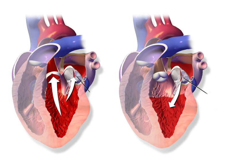 Góc giải đáp: Hẹp van tim 2 lá có chữa được không?